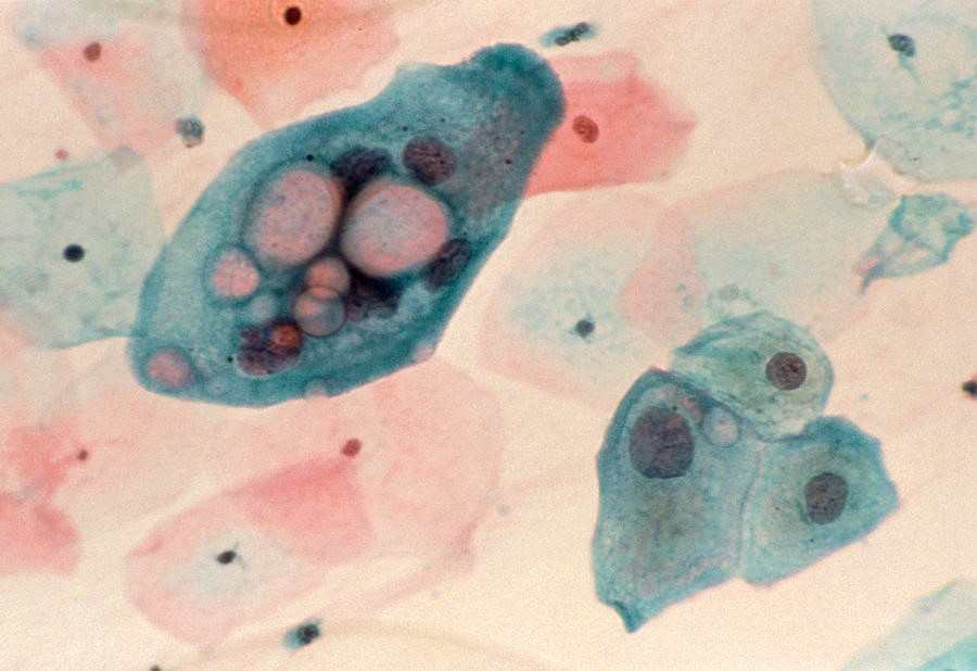 Chlamydia trachomatis